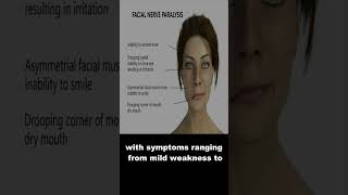 Understanding Bells Palsy Causus Symptoms and Treatment [upl. by Fleming610]