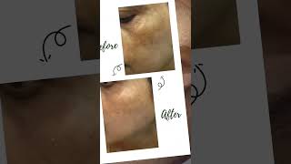 Cosmelan Peel Treatment [upl. by Thibaud809]