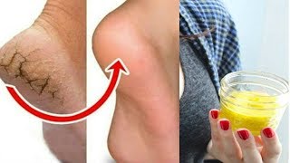 रातों रात फटी एड़ियां से छुटकारा पाये  इस उपाय से पैर भी हो जाएंगे गोरे  Cracked Heels Home Remedy [upl. by Annohsak]