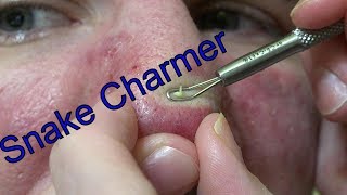 Nose Mania  Life With Cystic Acne Documentary 7 [upl. by Atteram307]