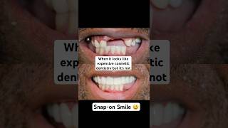 When it looks like expensive cosmetic dentistry but its Snapon Smile 😮 [upl. by Fante]