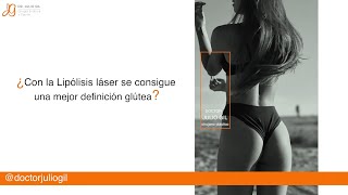 Lipolaser vs liposuccion Diferencias Riesgos ¿ideal para modelos Testimonio [upl. by Sillig710]