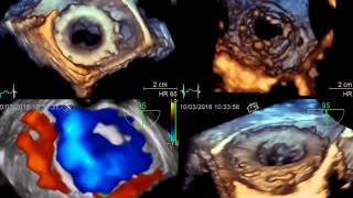 3D ECHO FOR PARAVALVULAR LEAK QUANTIFICATION [upl. by Fillender]