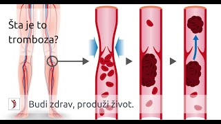 Šta je to Tromboza [upl. by Margret]