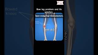 BOW LEG PROBLEM AND ITS SOLUTION [upl. by Kciderf]