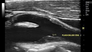 Indicações do Duplex Scan das Carótidas e quem pode fazer Escleroterapia com espuma [upl. by Yerrot752]