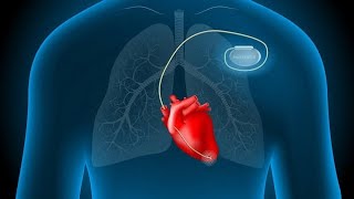 Placement of a pacemaker on the patients ♥ [upl. by Boor]