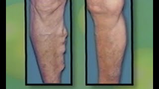 Varicose Vein Treatment by Laser  Endovenous Saphenous Vein Ablation  ELVES [upl. by Hanni]