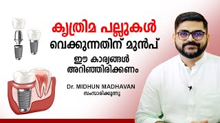 കൃത്രിമ പല്ലുകൾ വെക്കുന്നതിന് മുൻപ് ഈ കാര്യങ്ങൾ അറിഞ്ഞിരിക്കണം  Dental Implants  Health Tips [upl. by Kassia]