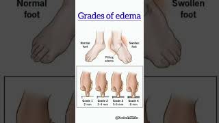 Grades of edema  viralshort gradesofedema edema pittingedema trending [upl. by Malorie]