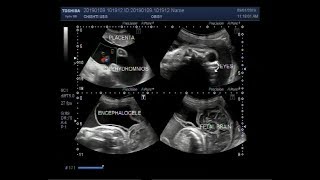 Ultrasound Video showing Anencephaly Encephalocele and Polyhdromnios [upl. by Neelat]