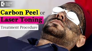 Treating Pigmentation using Carbon Peel  Laser Toning Treatment Video  Dr Rajdeep Mysore [upl. by Alessig]