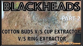 OLD BLACKHEAD REMOVAL WITH COTTON BUDS vs EXTRACTORS PART2 by DRLALIT KASANA [upl. by Nessy667]