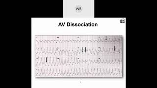 Wide Complex Tachyarrhythmias Part 2 Morphological Differences amp Identifying Factors [upl. by Lorrac581]