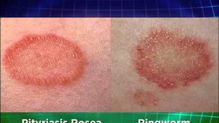 Ringworm Explained Medical Course [upl. by Eissel750]