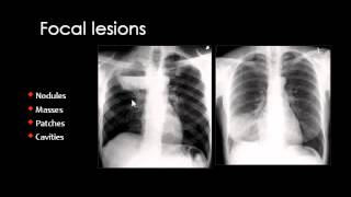 Chest XRay CXR in Arabic  Prof Mamdouh Mahfouz [upl. by Recor]