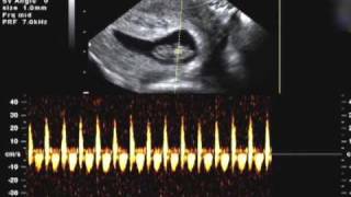 8 weeks 2 days Ultrasound Heartbeat [upl. by Adli]