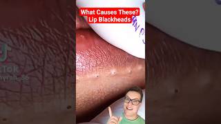 CRAZY BLACKHEAD REMOVAL AROUND LIPS shorts [upl. by Seiuqram]