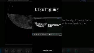 Ectopic Pregnancy [upl. by Glenn556]