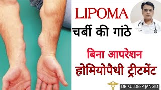 Best homeopathy treatment of lipoma । लिपोमा का बिना आपरेशन इलाज़ । Lipoma treatment । [upl. by Horter]