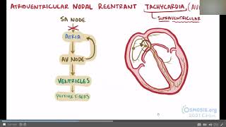 AVRT and AVNRT [upl. by Sosthina]