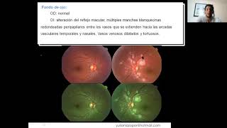 Angiopatía Traumática Retinal de Purtscher [upl. by Umeko]