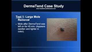 DERMATEND REVIEW Mole amp Skin Tag Removal Test [upl. by Rector777]