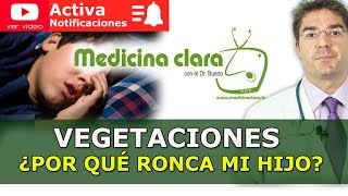 Vegetaciones Adenoides ¿Por qué ronca mi hijo Apneas del sueño en niños [upl. by Ecnarual]