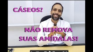 Você tem CÁSEOS Não REMOVA suas AMÍDALAS [upl. by Ravens61]