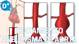 Causas y tratamiento de las Aneurismas de Aorta [upl. by Mannes]