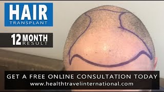 FUE Hair Transplant  12 Month Result  Hairline Restoration  Hair Loss Before amp After [upl. by Nohsav]