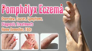 Pompholyx eczema causes symptoms diagnosis treatment home remedies FAQ  Dyshidrotic eczema [upl. by Armahs872]