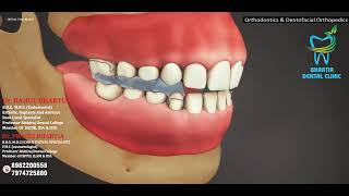 Functional appliances orthodontist Bhartia Dental clinic [upl. by Sekyere]