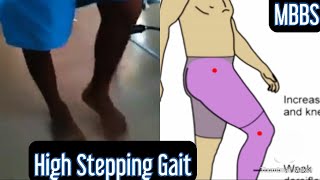 High Stepping Gait Foot Drop [upl. by Ffoeg682]