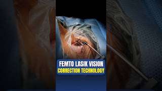 Live Femto Lasik Vision Correction Surgery [upl. by Yren]