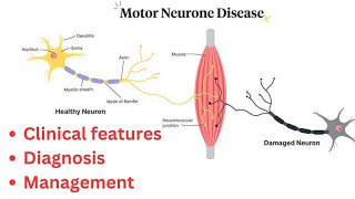 Motor Neuron Diseases Symptoms Diagnosis and Treatment Options [upl. by Carlyn525]