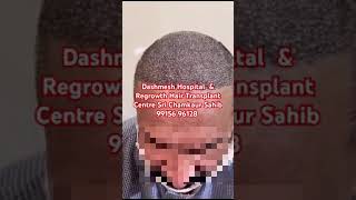 9000 grafts hair transplant [upl. by Kettie]