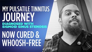 I cured my Pulsatile Tinnitus and now whooshfree diagnosed with Sigmoid Sinus Stenosis [upl. by Jennie955]