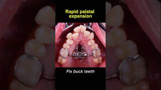 Expand upper teeth with rapid palatal expander braces orthodontist dentist [upl. by Isdnyl]