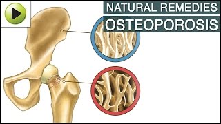 Aches amp Pains  Osteoporosis  Natural Ayurvedic Home Remedies [upl. by Becht]