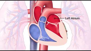 Mitral Valve Regurgitation [upl. by Norward]