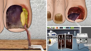 ASMR Ingrown Toenail removal treatment animation relax  리얼한 내성 발톱 케어 애니메이션 [upl. by Rep]