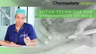 BOTOX TECHNIQUE FOR HYPERHIDROSIS OF PALM [upl. by Morril793]