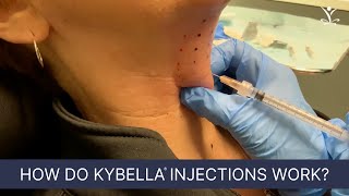 Get Rid of a Double Chin with Kybella [upl. by Yoj329]