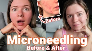 All About Microneedling Vlog  Before After and Everything in Between Healing PostAcne Skin [upl. by Ajoop]