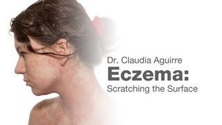 Eczema Scratching the Surface [upl. by Ahsitil]