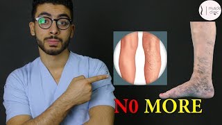 ما هى دوالى الساقين ؟  علاج مشكلة الدوالى نهائيا varicose veins treatment [upl. by Galven]