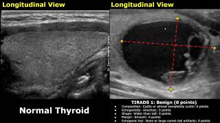 ACR TIRADS Classification Of Thyroid Nodules Ultrasound  Thyroid Imaging Reporting and Data System [upl. by Anaitsirk]