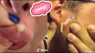 Satisfying Blackhead Removal Compilation  Best Techniques for Clear Skin [upl. by Clabo258]