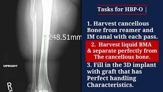 Hensler Bone Press  Ortho  TTC nailing [upl. by Paige]